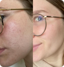 ALLVERO™  Çene Toparlayıcı Maske – Gıdı Karşıtı Kolajen Maske