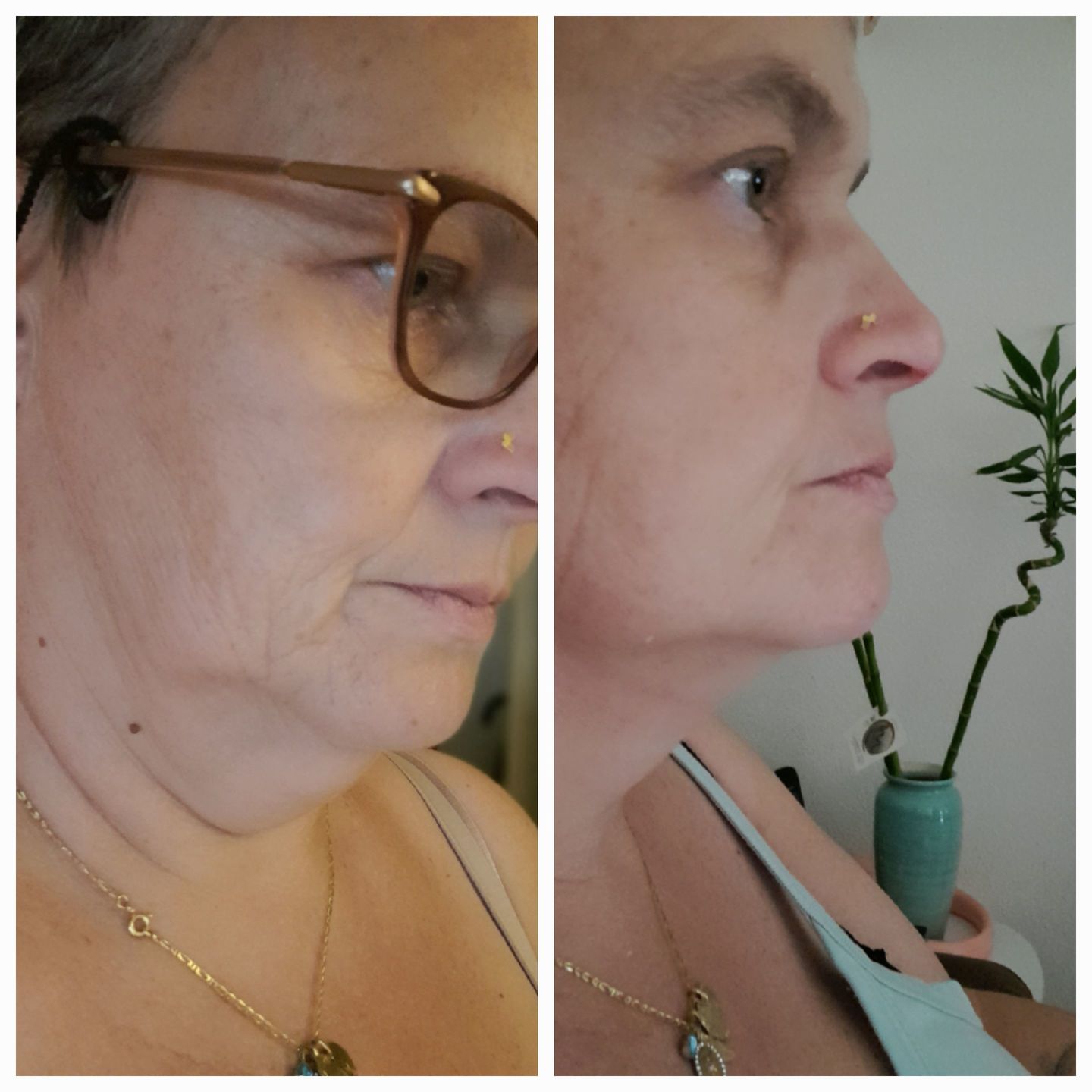 ALLVERO™  Çene Toparlayıcı Maske – Gıdı Karşıtı Kolajen Maske